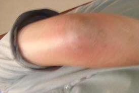 如何防止風濕病複發?複發的原因是什麽呢?