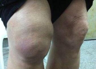 痛風疼痛有何特點?該如何護理呢?