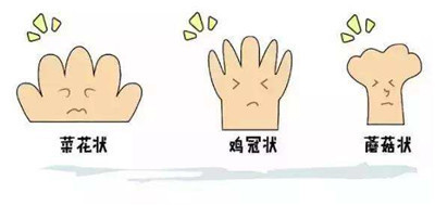 尖銳濕疣怎麽感染肛部的呢?早看早預防哦！