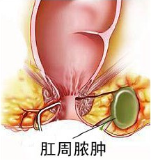 肛周膿腫是怎麽引起的？手術治療要注意什麽？