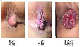 痔瘡手術過程需要多長時間 你知道嗎