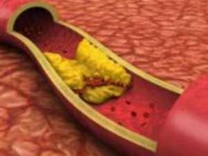 冠狀動脈斑塊如何消除，這樣做有效果