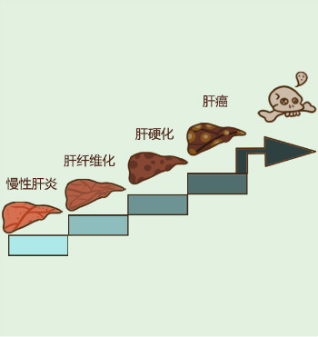 肝硬化的前期表現有哪些？肝硬化前期該如何選擇軟肝藥品呢？