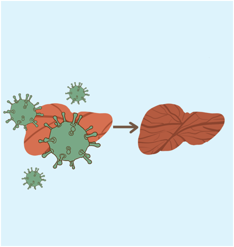 軟肝服什麽藥效果好?這款軟肝片一直備受肝病患者青睐