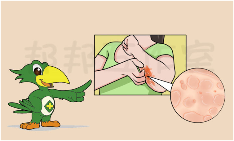 荨麻疹越抓越癢範圍擴大如何是好？這樣來解決