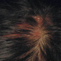 消除誘因才好進行脂溢性脫發治療