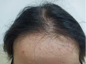 産後脫發怎麽回事？治療産後脫發的藥物有什麽？