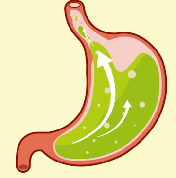 如何治療胃酸反流？這兩種方法可以試一試！