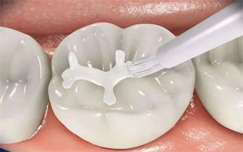 鄭州臻爵口腔2025價目表揭密，種植牙2980元起、隐形矯正15800元起、牙齒美白500元起