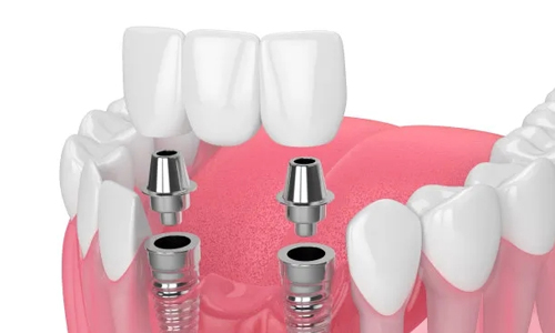 合肥蜀山區種植牙哪家好？治仁、新安、宸貝正規的牙科更加具有可靠性