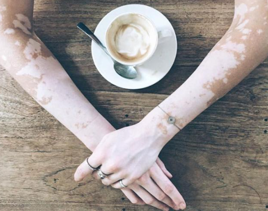 手部出現了白癜風應該怎麽辦呢