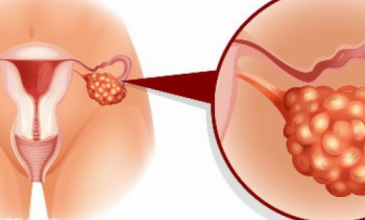 〖卵巢粘連影響試管嬰兒嗎？卵巢粘連能做試管嬰兒嗎？〗