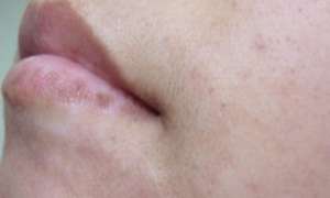 飲食偏方治療白癜風