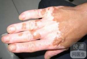 老年白癜風飲食護理  三大飲食護理注意事項