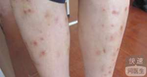 中藥可以治療牛皮癬嗎 教你用中藥緩解皮損症狀