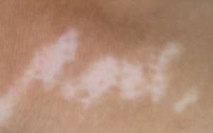 白癜風的病因與注意事項