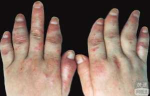 牛皮癬的病因有哪些  牛皮癬究竟有哪些危害