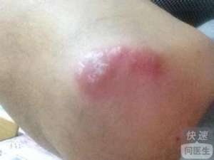 牛皮癬有什麽危害  怎麽診斷其發生