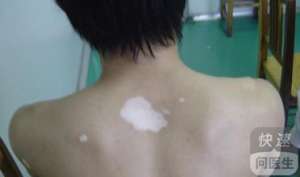 白癫風太可怕應該如何預防 預防白癜風的五種方法