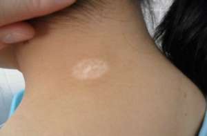 白癜風治療方案