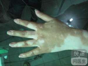 白癫風是由于什麽會引起的 壓力過大也會導緻白癫風