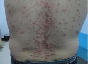 有關治療牛皮癬的兩大原則的介紹