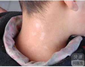 白癫風治療起來要注意些什麽？白癫風需要注意的事項