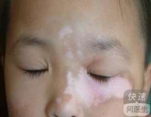 3歲小孩白癜風的早期症狀 四大症狀需要警惕