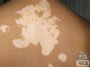 白癜風比較難治療的因素是什麽？