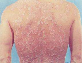 牛皮癬要怎麽進行治療？