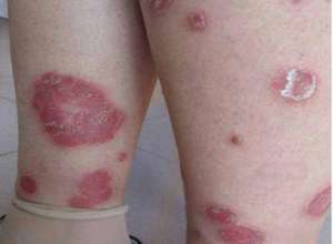 探讨怎樣防治牛皮癬複發