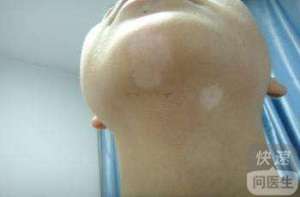 白斑診斷爲白癜風了怎麽治 治療白癜風需要注意三點