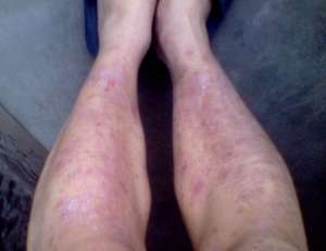 關于牛皮癬治療辦法都有哪些