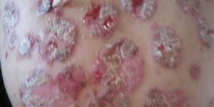 介紹有關牛皮癬用什麽藥膏好用