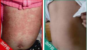 淺析患上牛皮癬真的傳染嗎