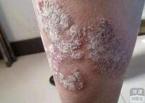 牛皮癬治療注意事項有哪些