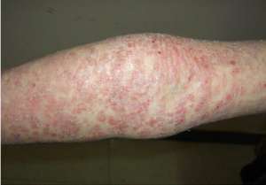 淺談牛皮癬的治療方法要如何選擇