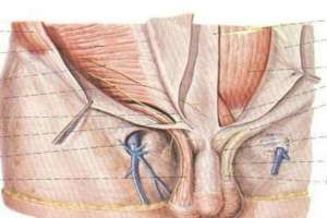 精索靜脈曲張的手術治療