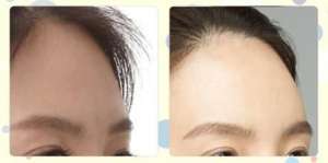 豐額頭的前後對比圖