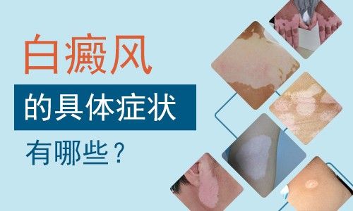 青少年白癜風有哪些症狀?肇慶專業白癜風醫院