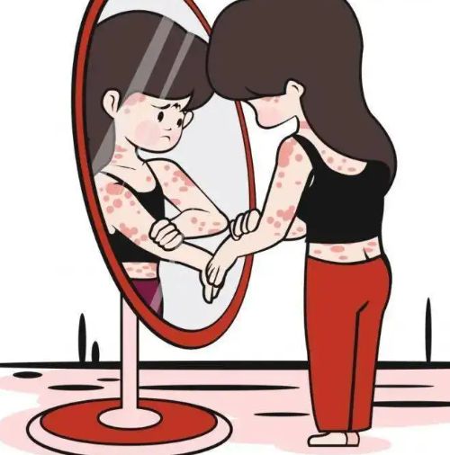 重要宣布:濟南牛皮癬醫院哪家好“解決難題”牛皮癬發作的症狀