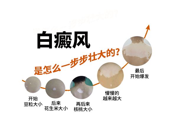 專家分享！廣州哪家醫院看白癜風好公開排名總榜-藥物治療是尋常型白癜風要怎麽做才好呢?