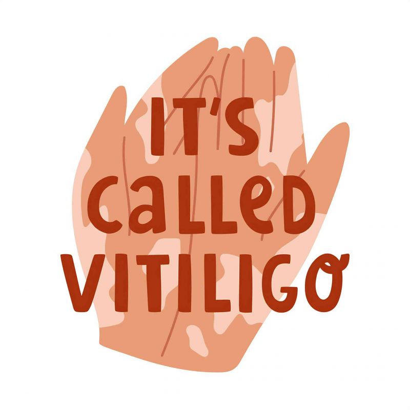 今日看點！蘭州治白癜風醫院排名 身上出現白斑後用藥後爲什麽白斑還會擴散呢